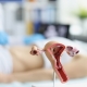 Anatomical model of a uterus and ovaries in front of a female patient being examined, showing the long-term success of uterine fibroid embolisation
