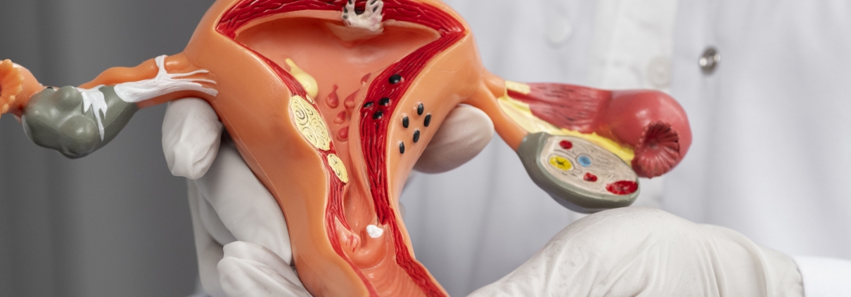 Doctor holding anatomic model of multiple uterine fibroids.