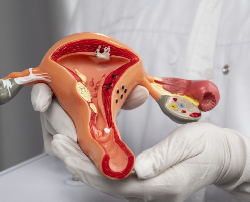 Doctor holding anatomic model of multiple uterine fibroids.