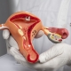 Doctor holding anatomic model of multiple uterine fibroids.